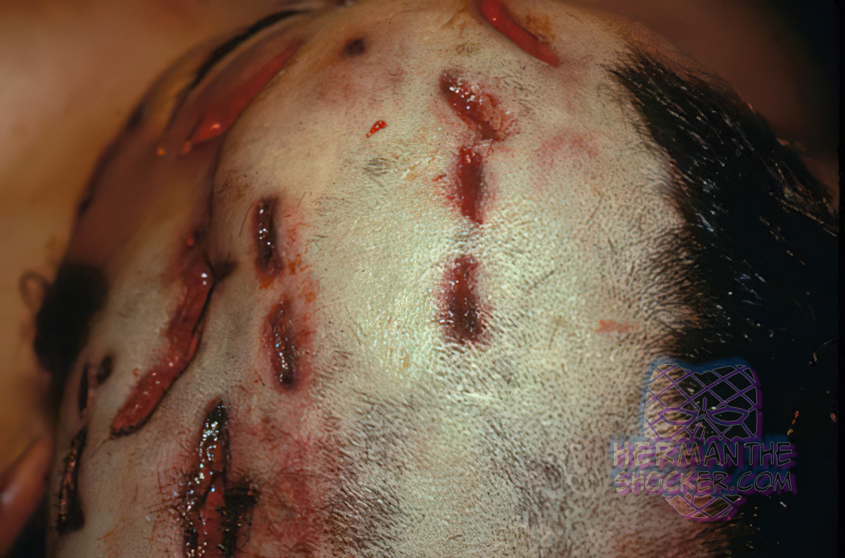 Patterned lacerations from a hammer