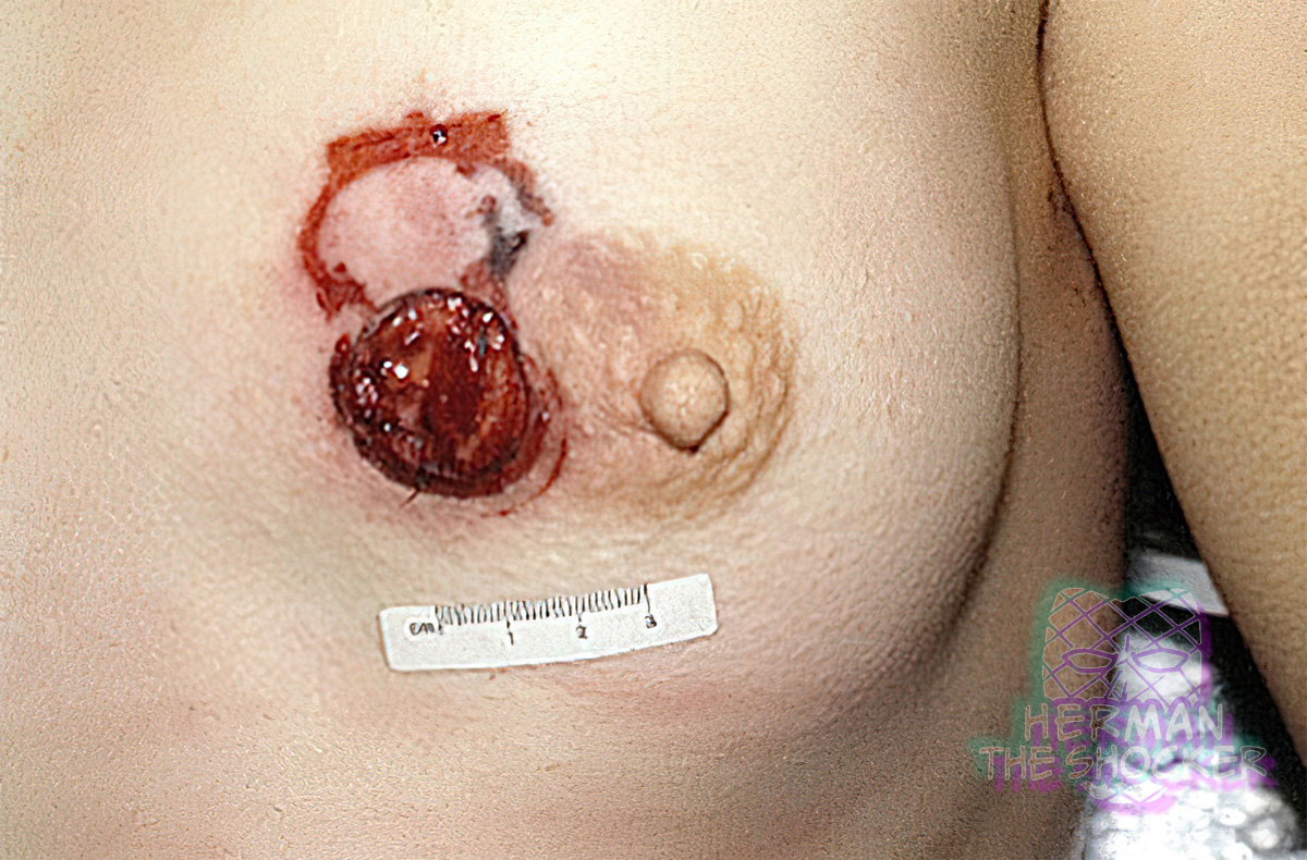 Contact wound of the left breast