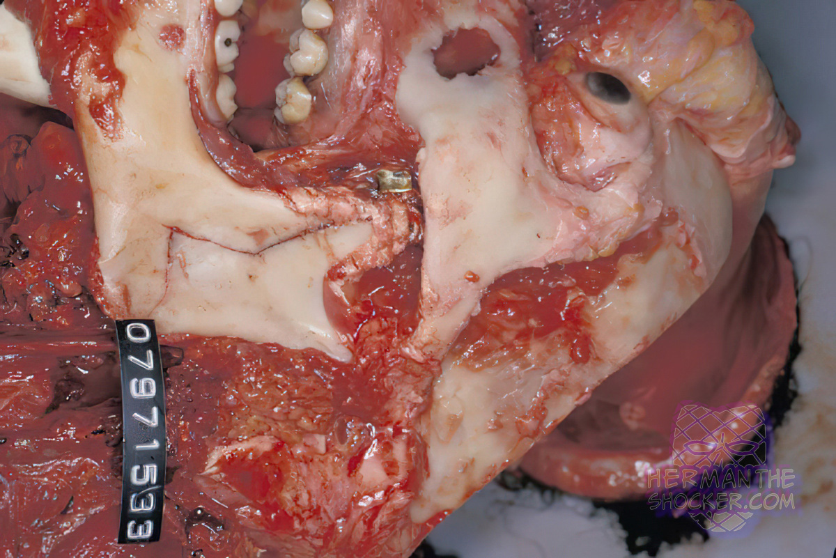 Facial dissection