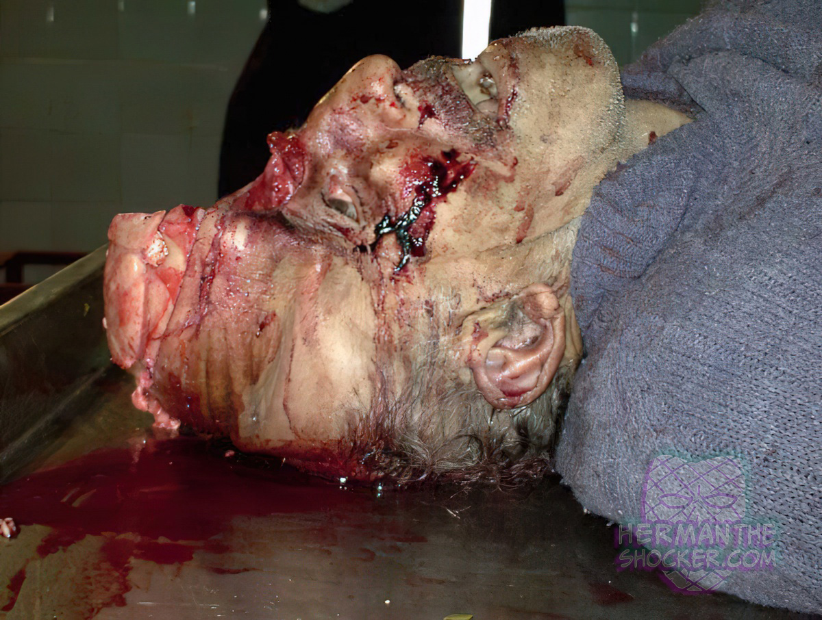 Crushing head injury