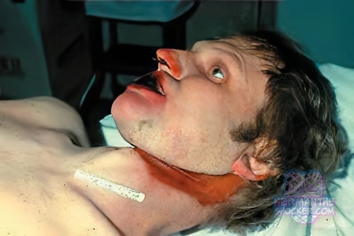 Patterned abrasion on neck in autoerotic death