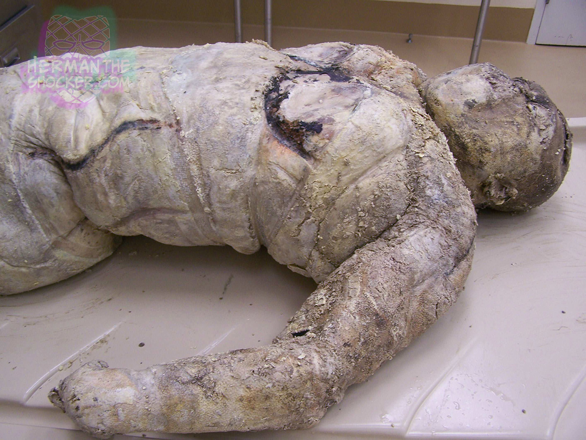 Adipocere on a corpse