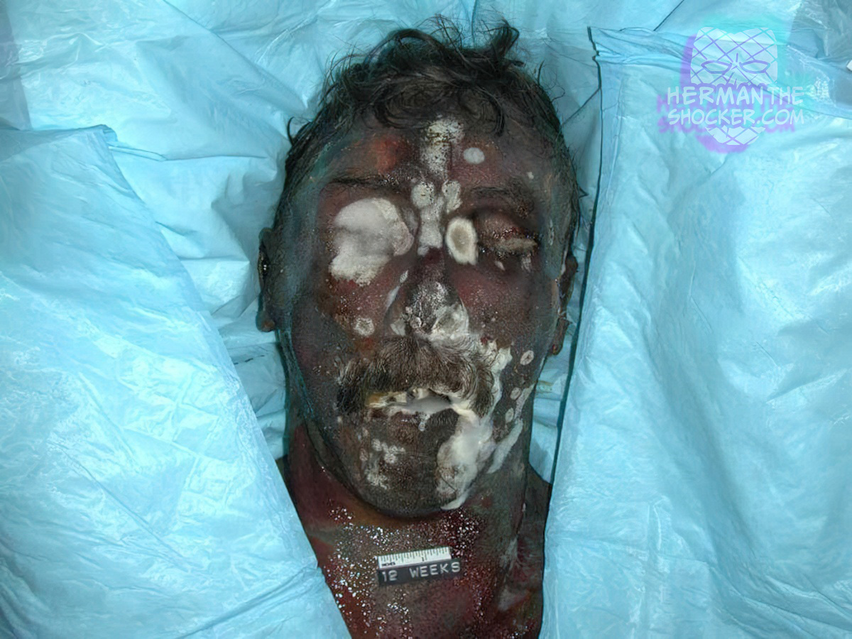 Fungal colonies growing on the face of a decomposing corpse