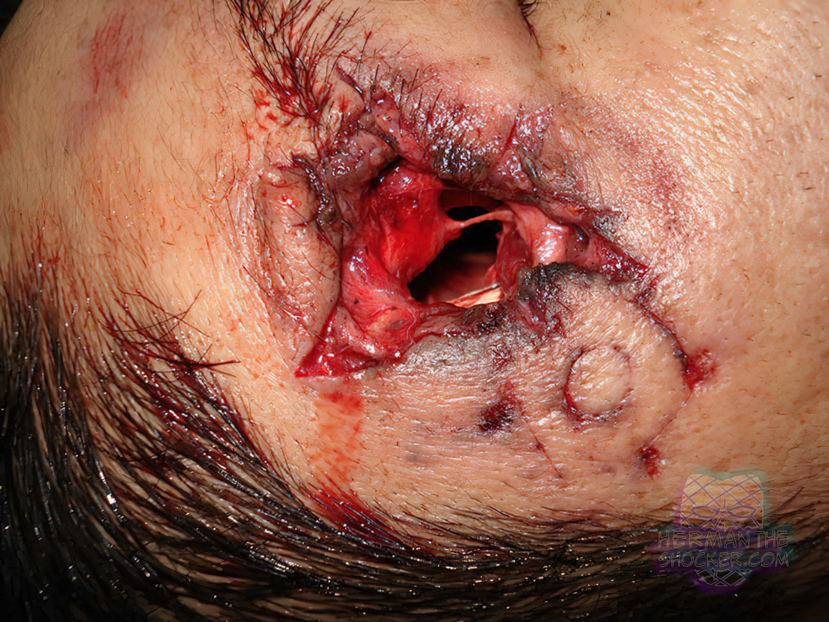 Gunshot wound with muzzle imprint
