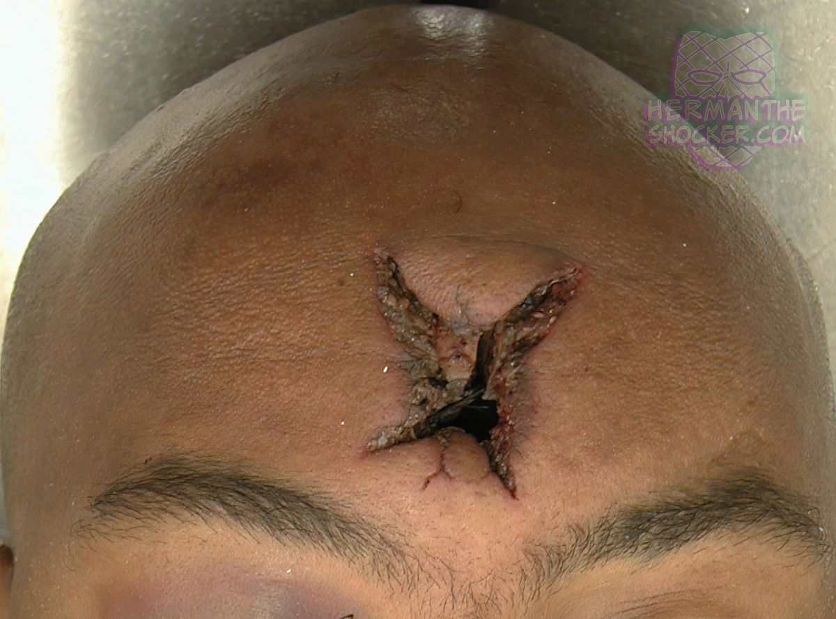 Stellate-shaped contact wound of the forehead