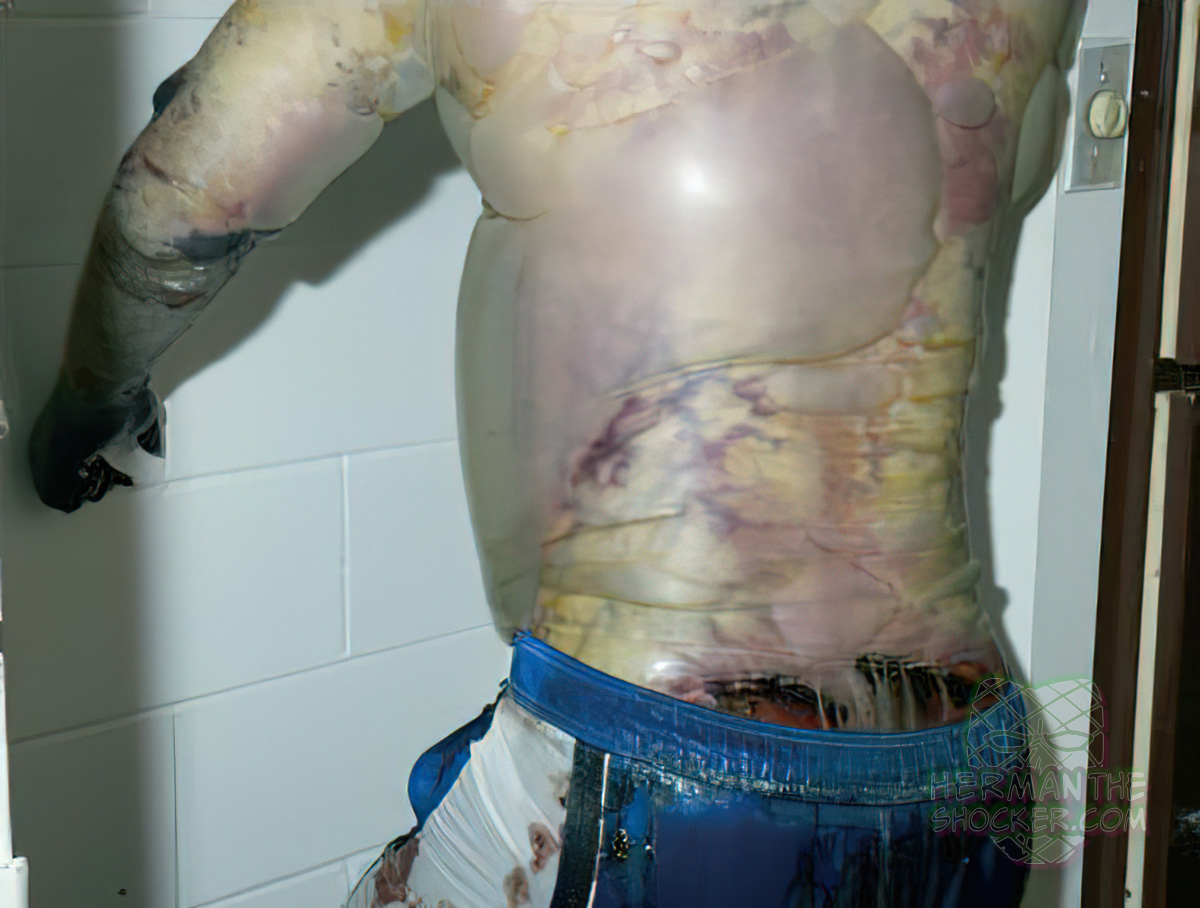 Putrified suicide victim