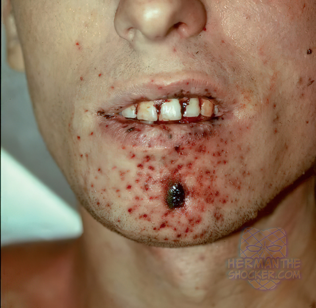 Gunshot wound tattooing
