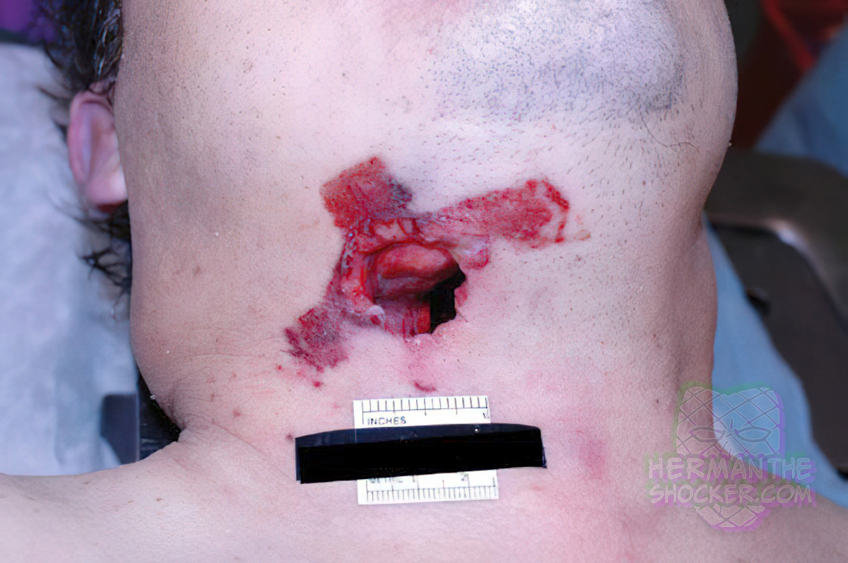 Close-range shotgun entrance wound