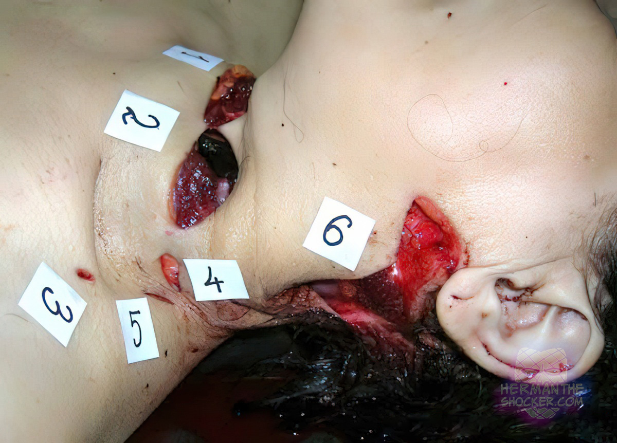 Fatal stab-cut and incised wounds