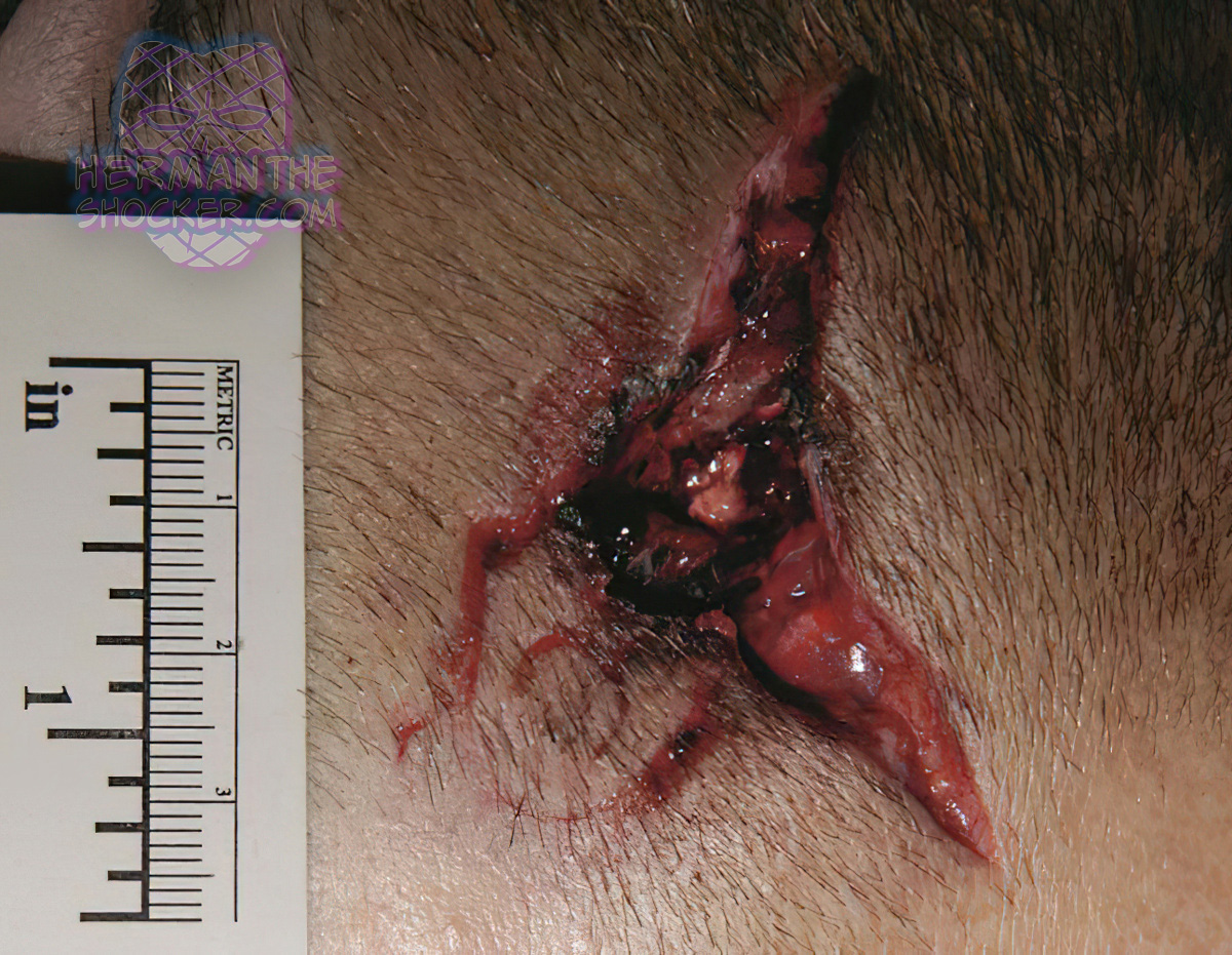 Muzzle stamp abrasion with blow back lacerations