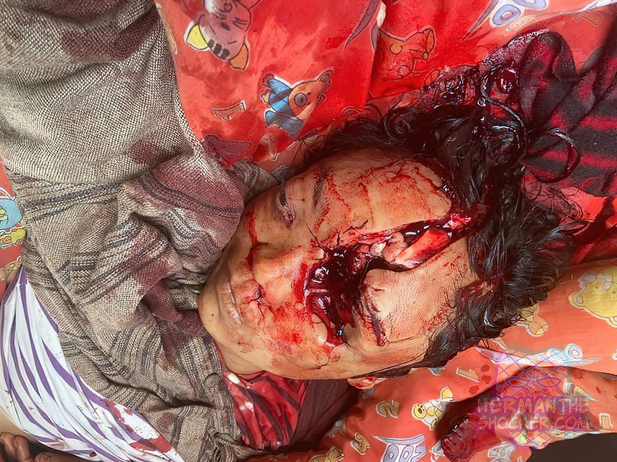 A civilian was shot in the head during a protest