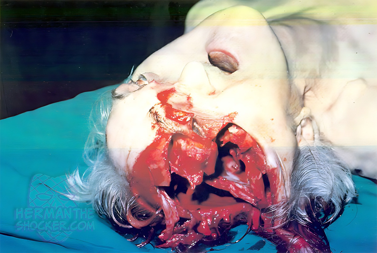 Skull burst fracture from fall from height