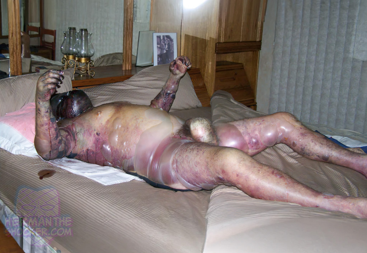 Body in a state of decomposition