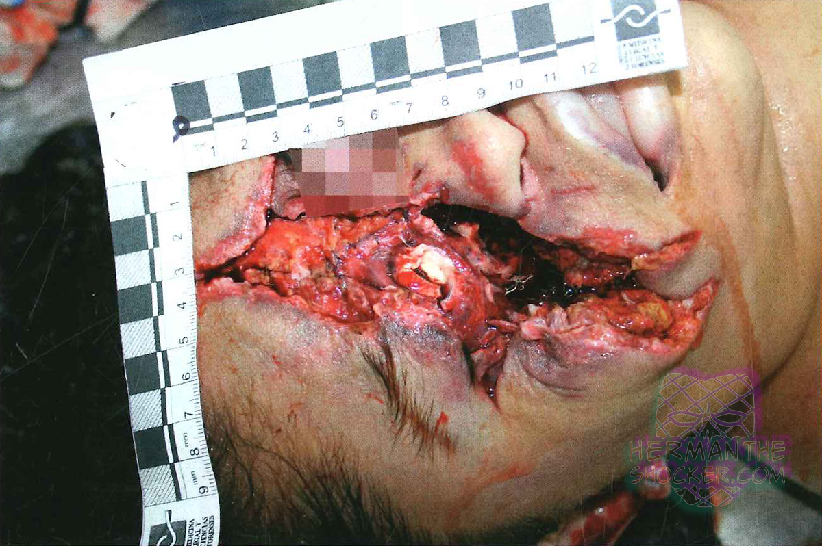 Gunshot wound to the face