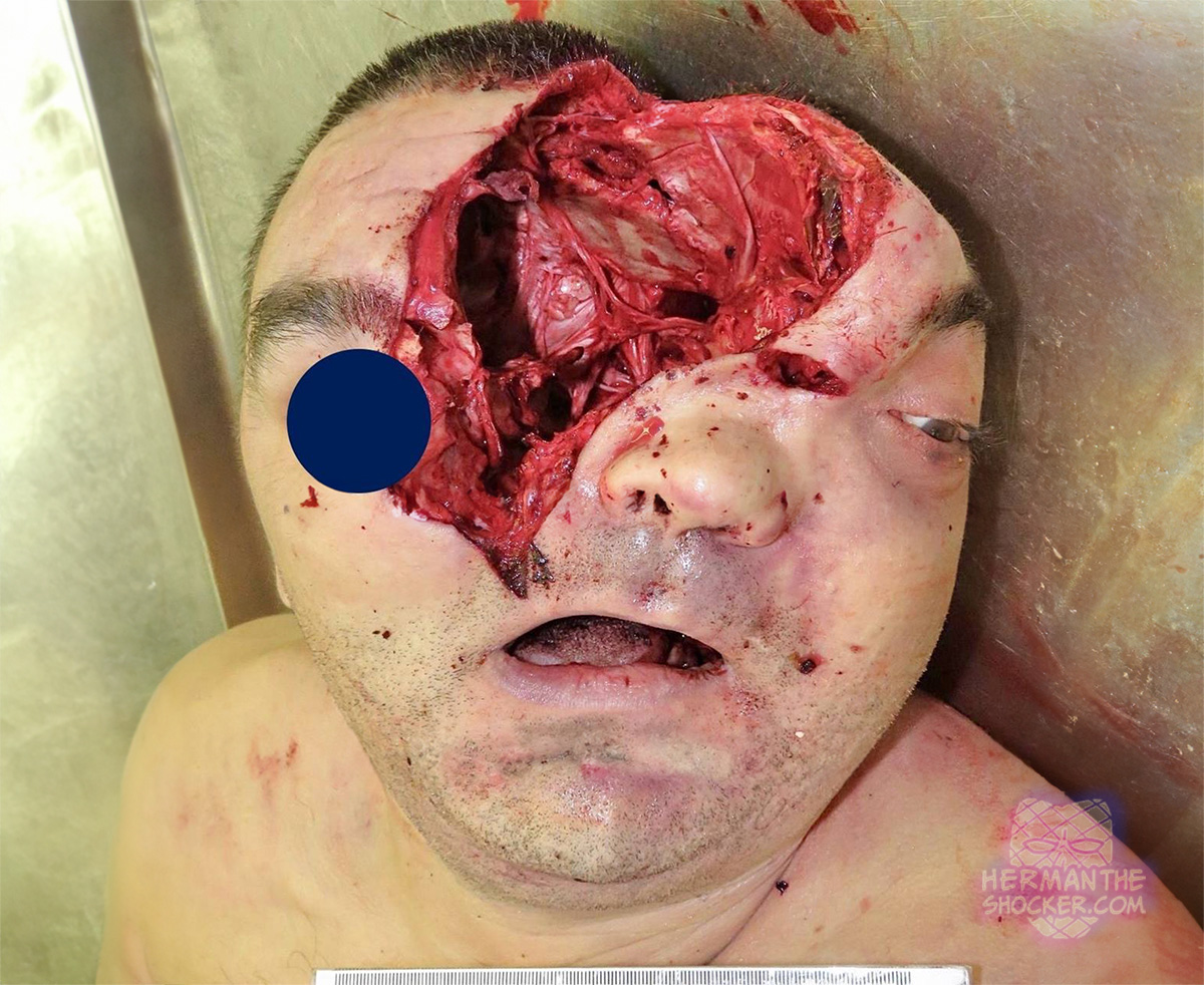 Gunshot to the head in a suicide