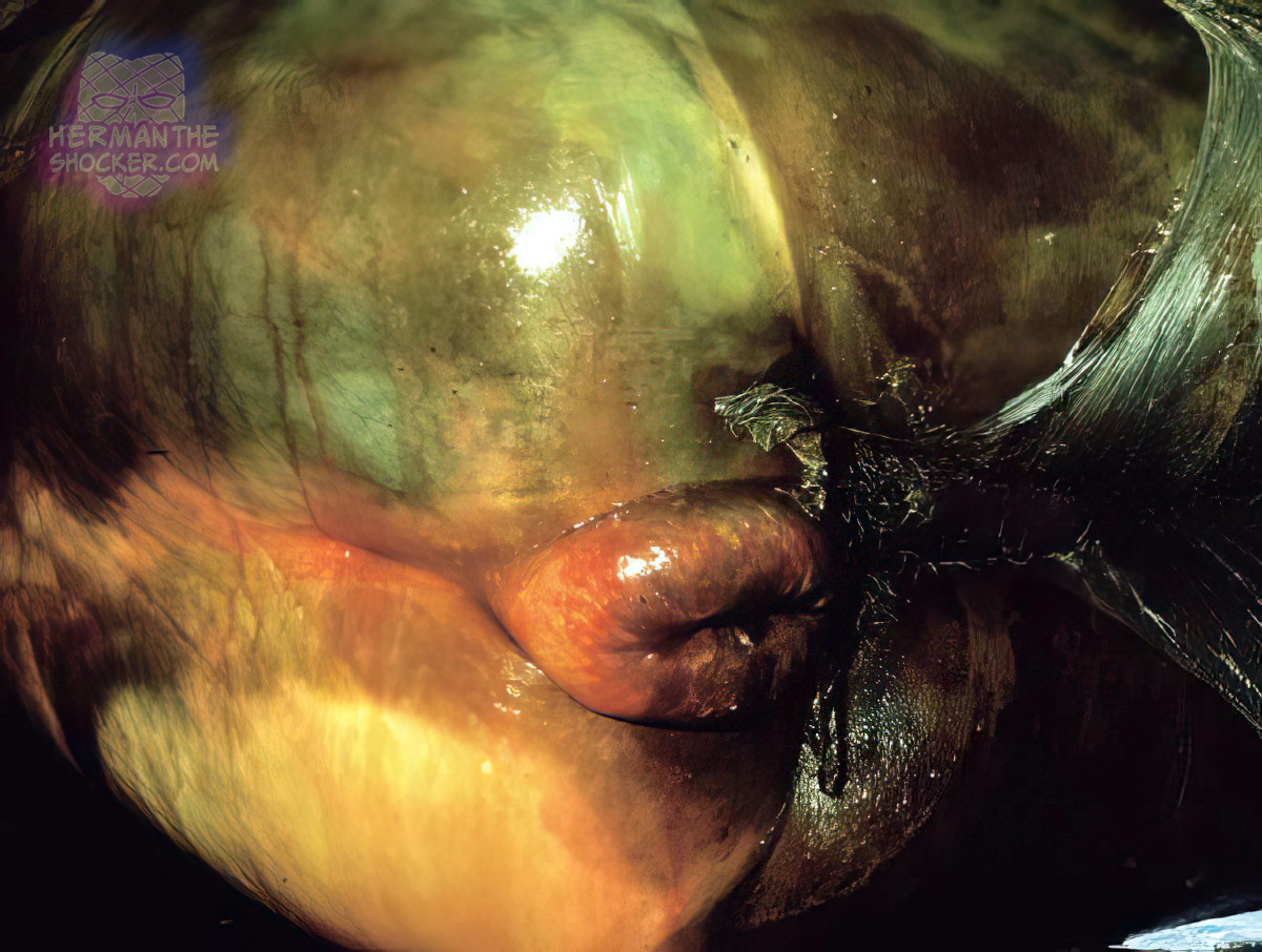 Bloated anus