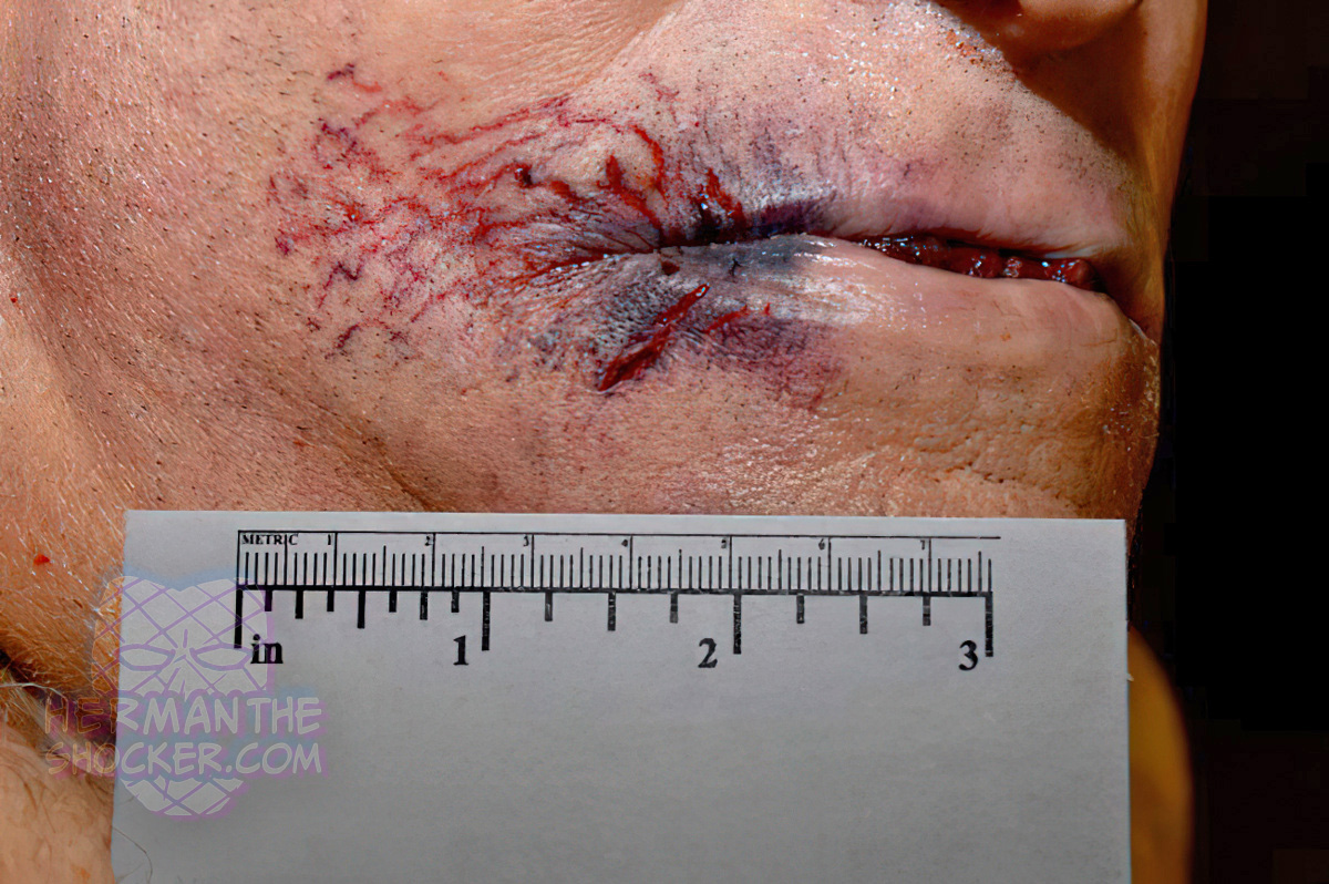 Perioral lacerations from an intraoral gunshot wound