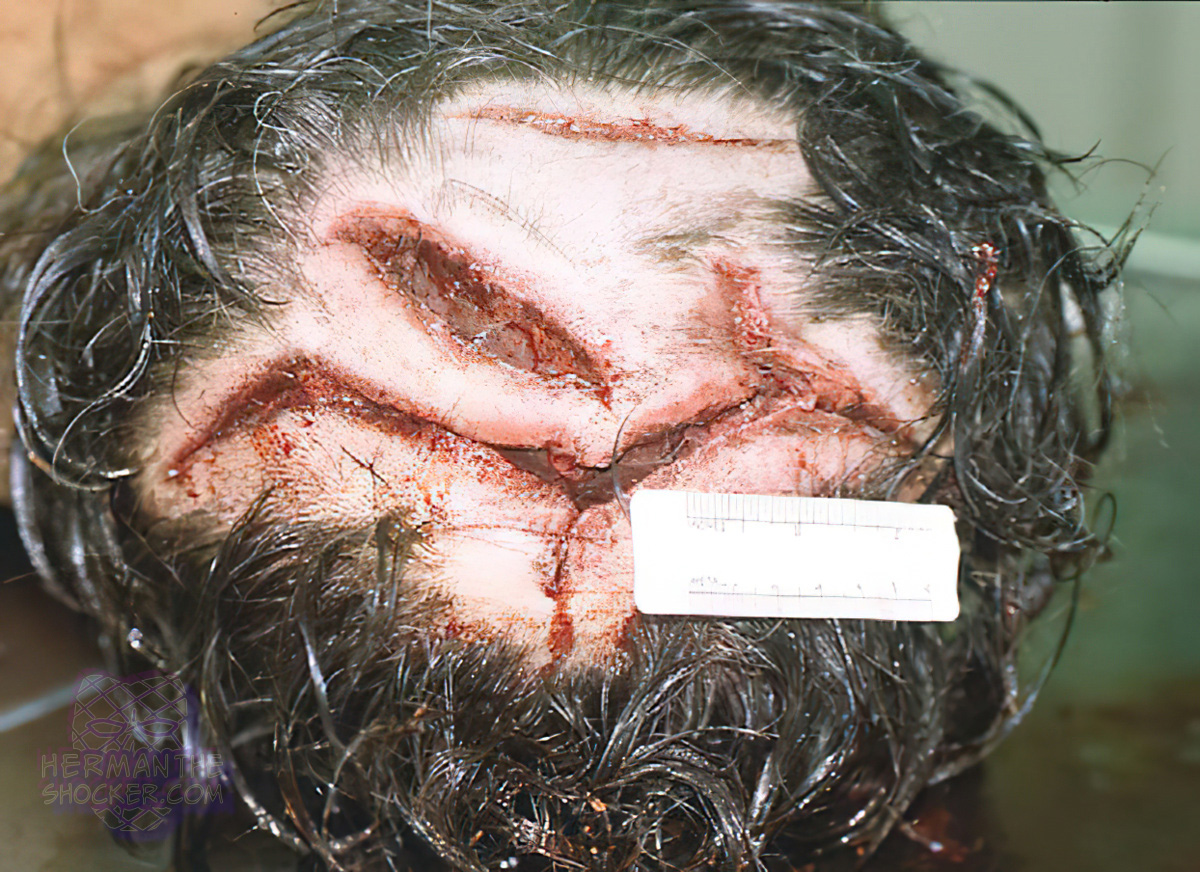 Lacerations with abrasions along the wound margins