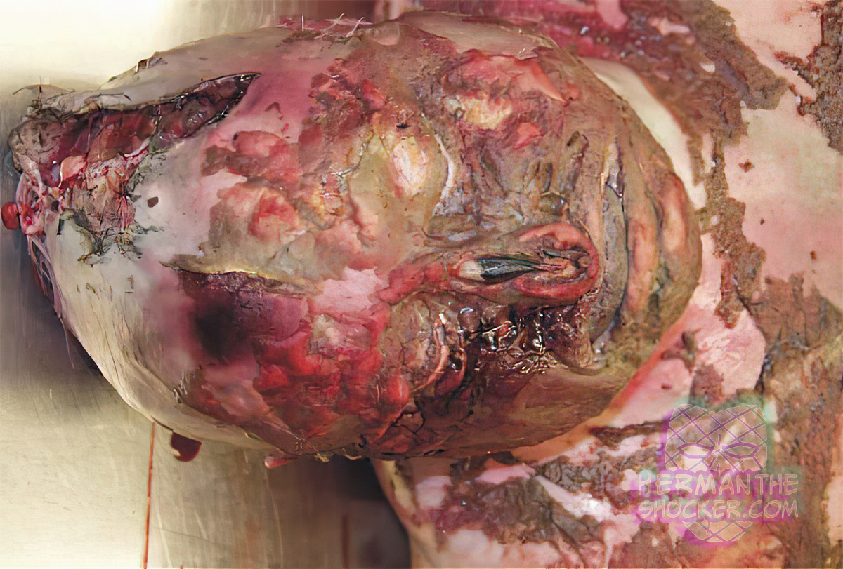 Fatal head injury from a boat propeller