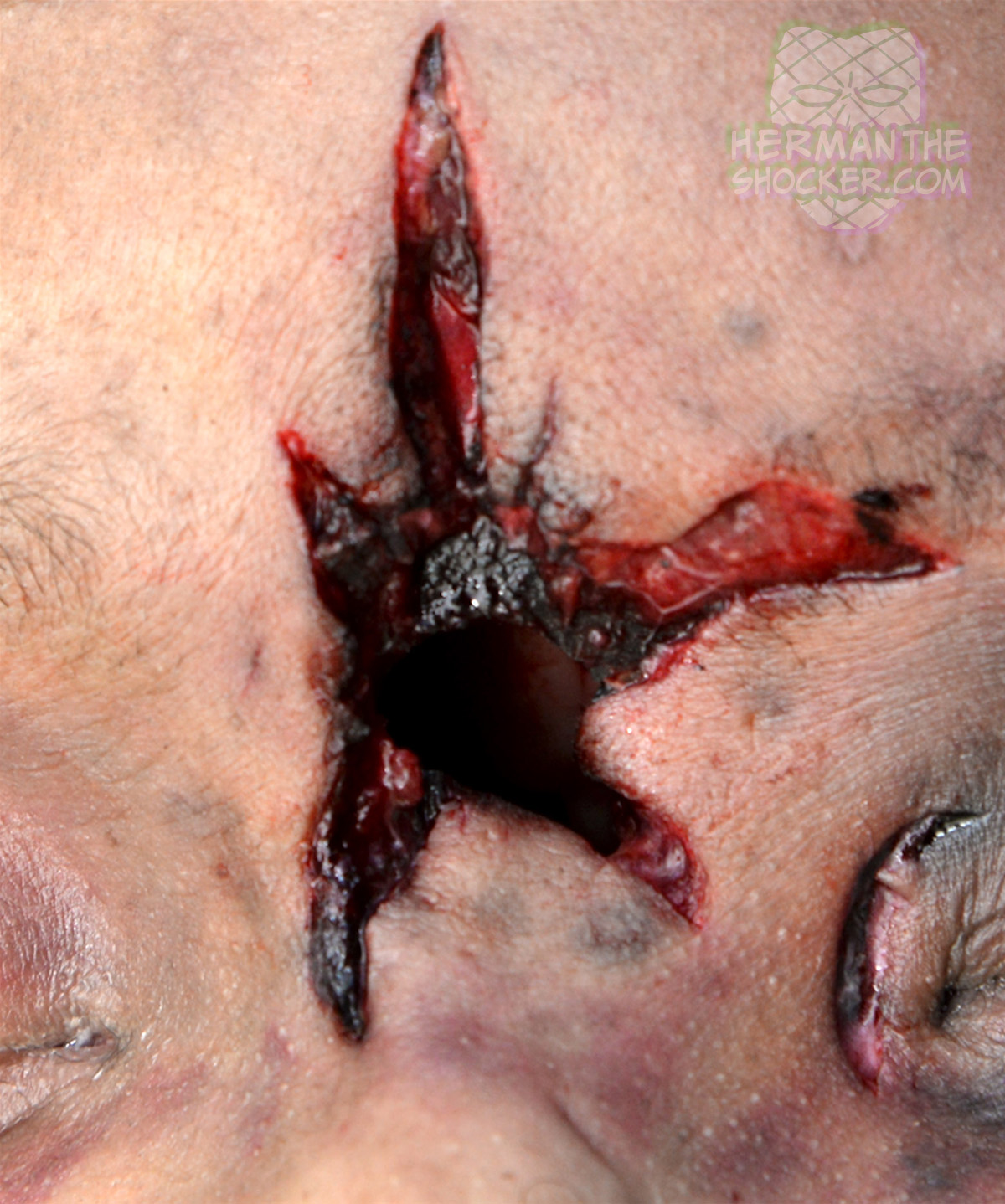 Stellate gunshot wound