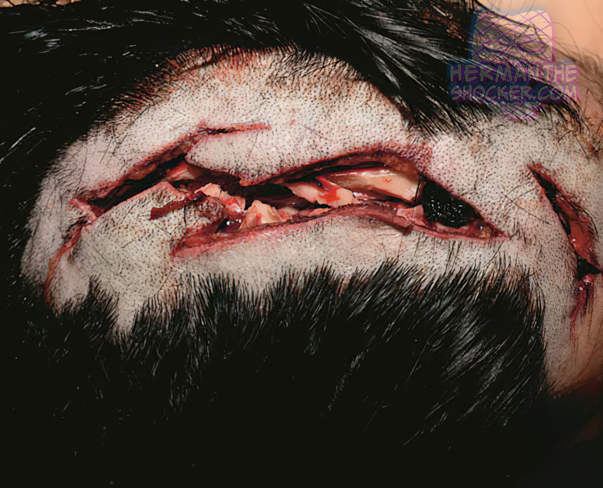 Chop wounds of the scalp