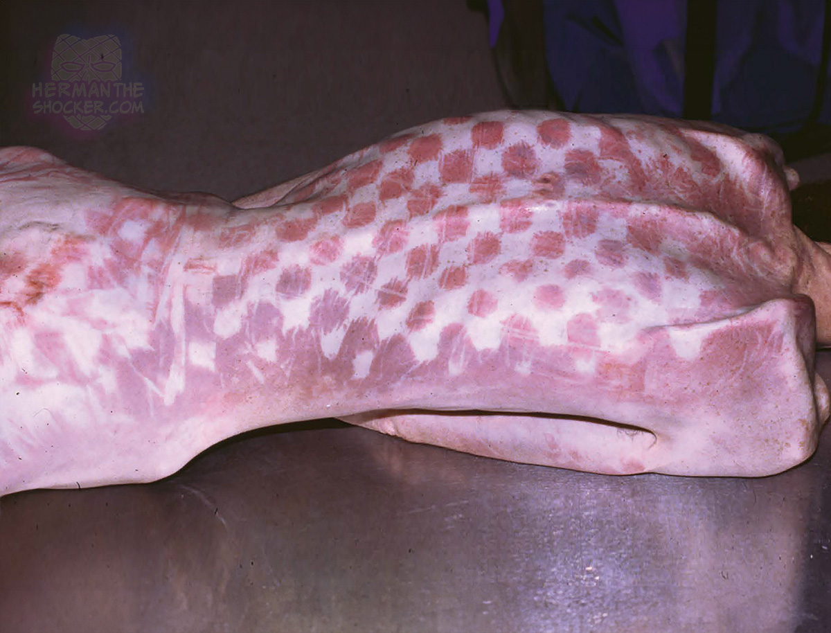 Patterned livor mortis