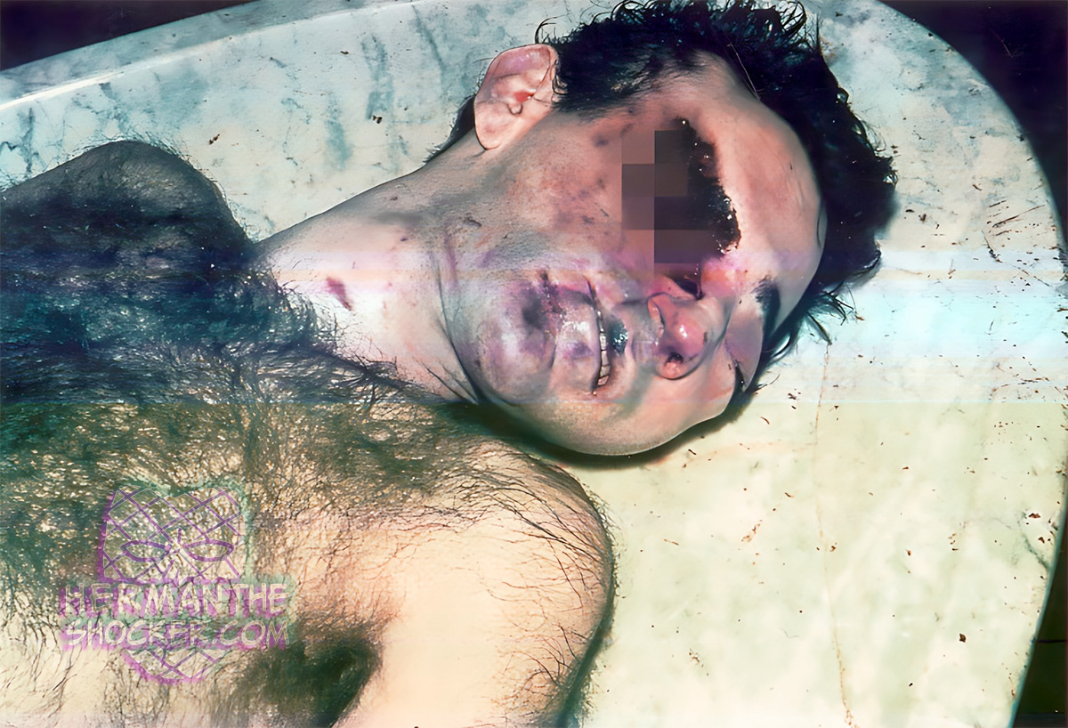 Fatal contusions with a blunt object