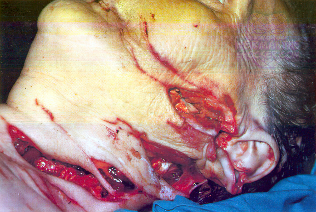 Homicidal throat cut