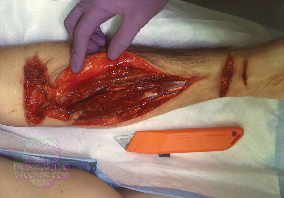 Suicidal cuts using a box cutter