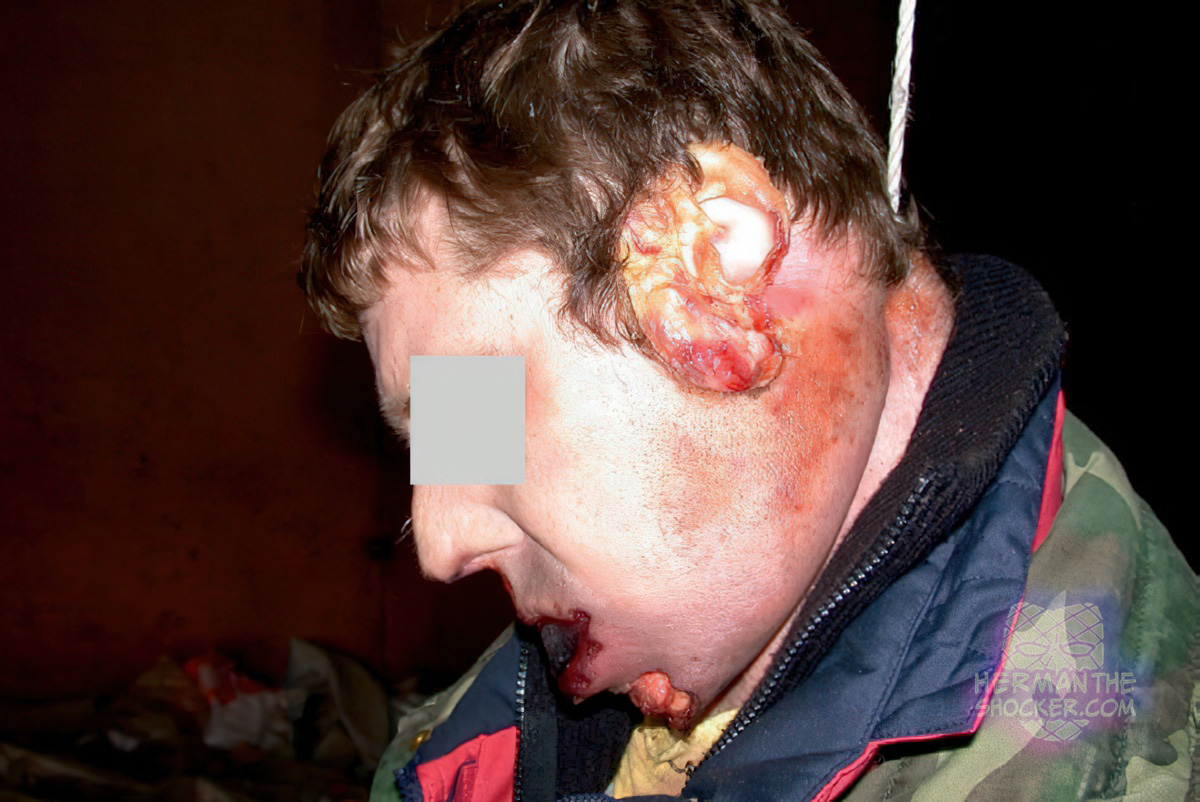 Postmortem animal activity on a suicide victim
