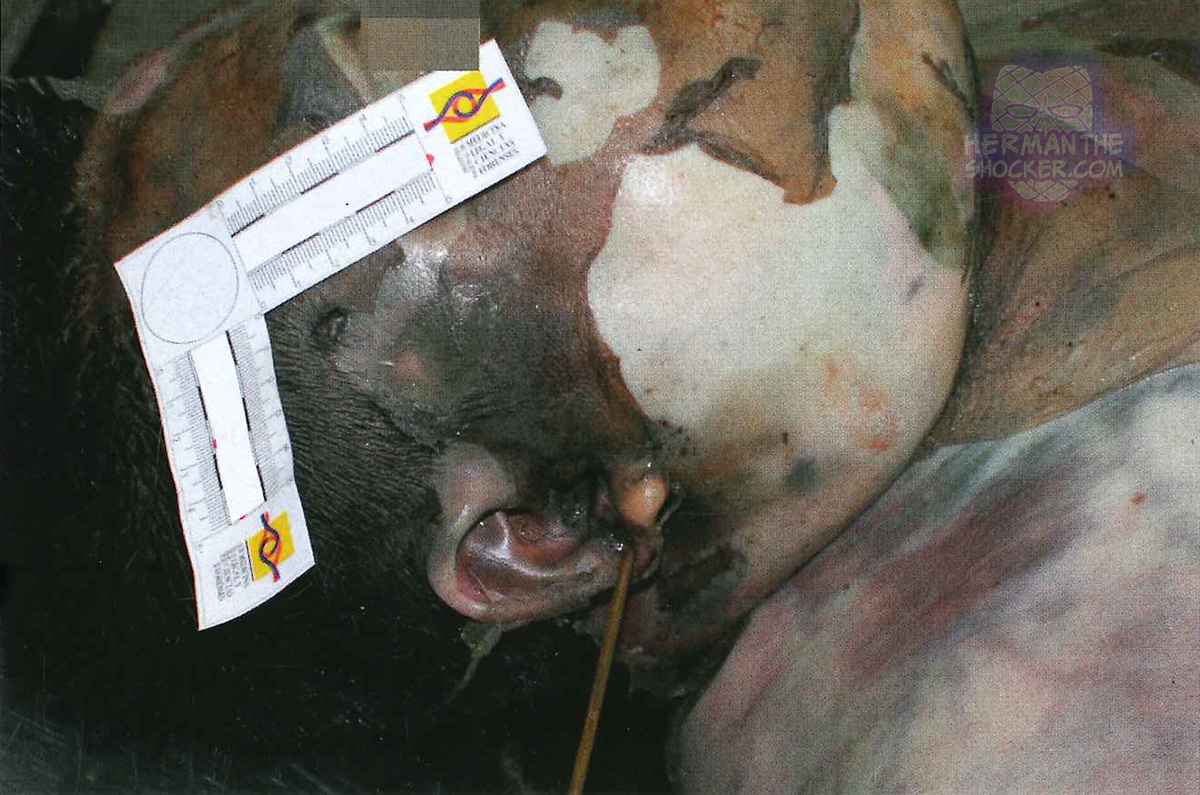 High-velocity gunshot wound