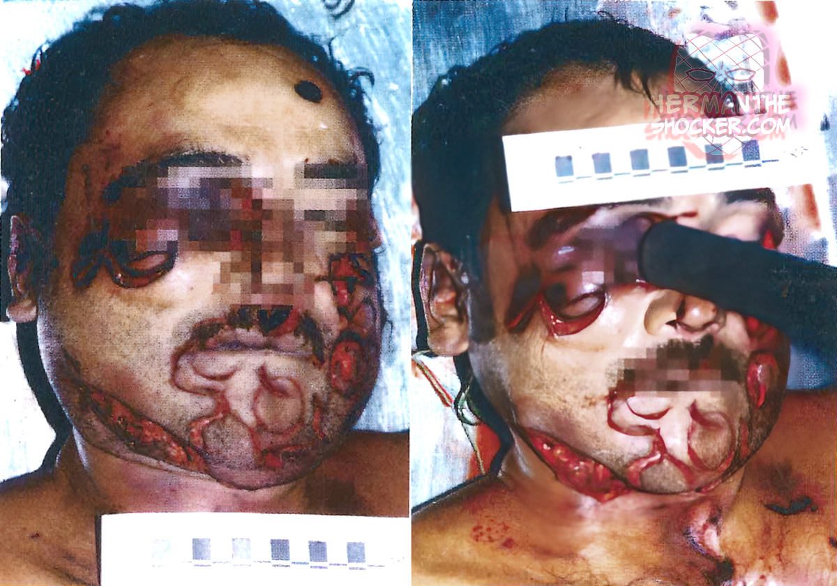 Man struck multiple times in the face with a metal pipe
