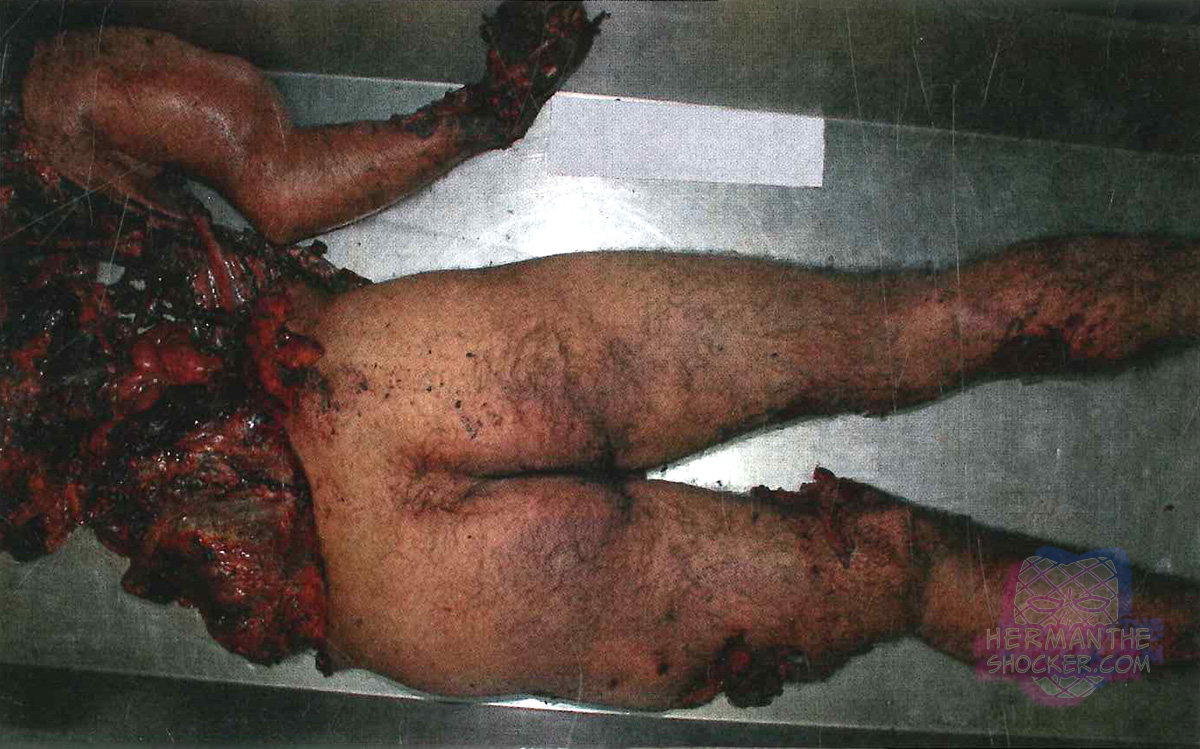 A victim of an explosion