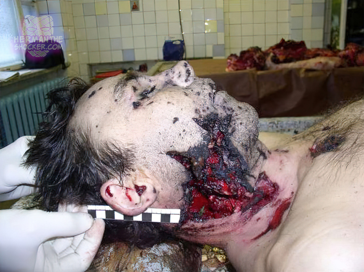 Fatal injury after a shell explosion