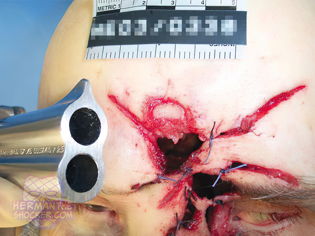 Contact gunshot wound