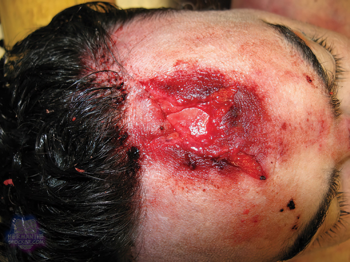 Laceration of the forehead