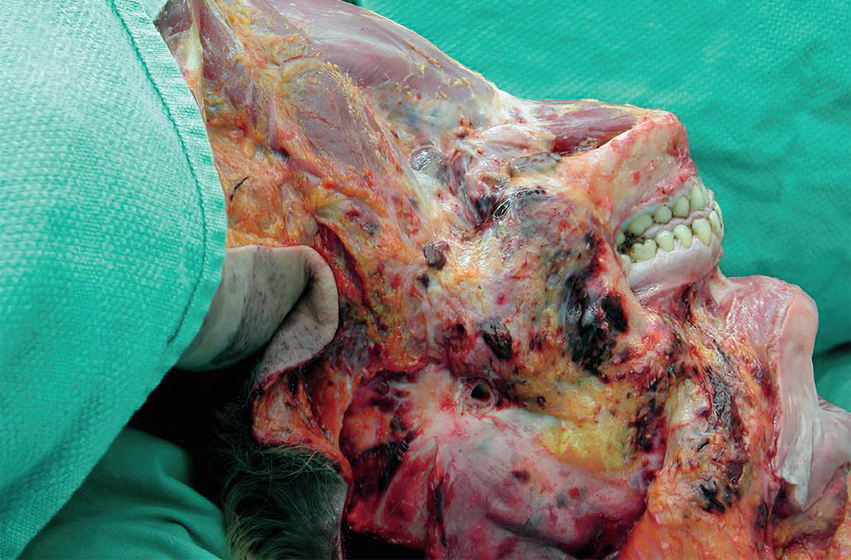 Neck dissection in a 36-year-old woman