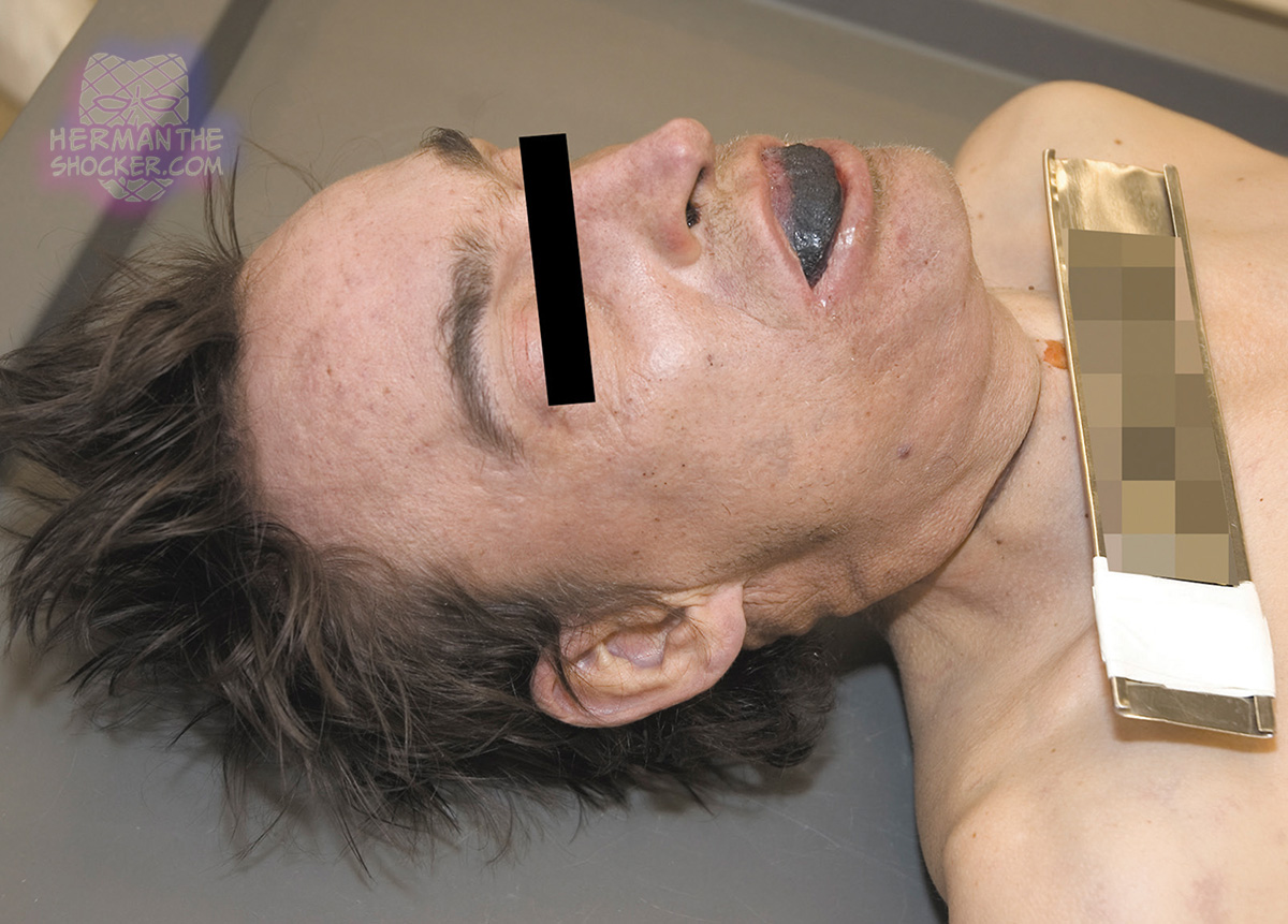 Protrusion of the tongue with dark discoloration