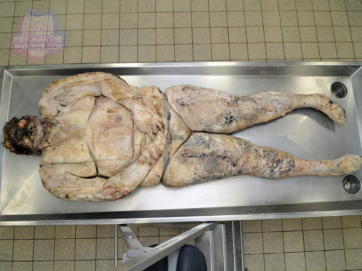 Adipocere formation after 2.5 years in a grave