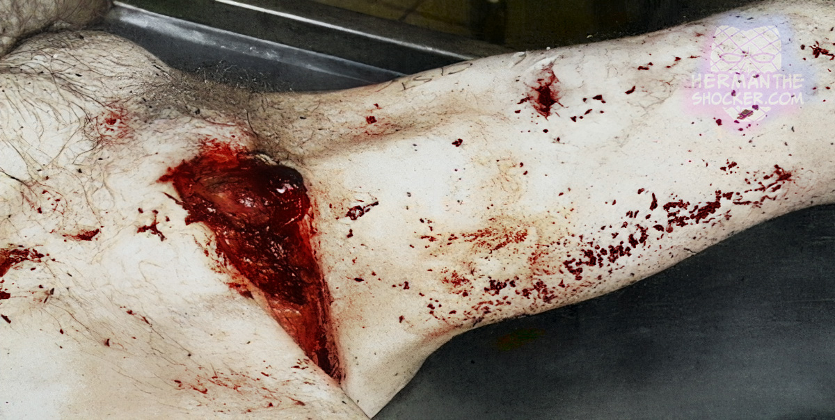 Complete self-amputation of the scrotum and penis with scissors