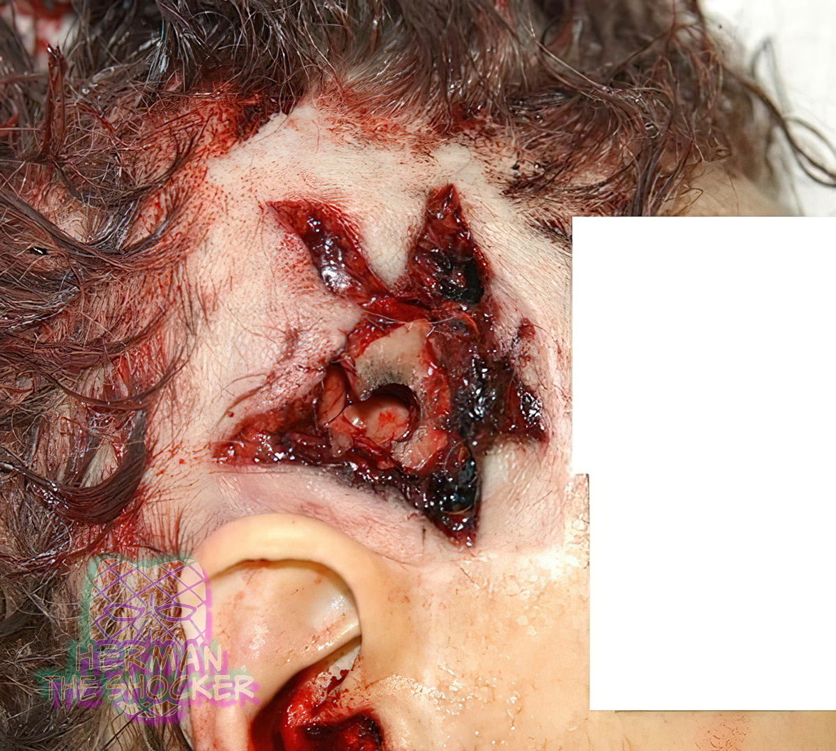 Gunshot wound on the side of the head