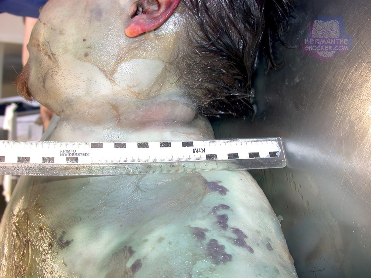 Putrefactive blisters and skin slippage