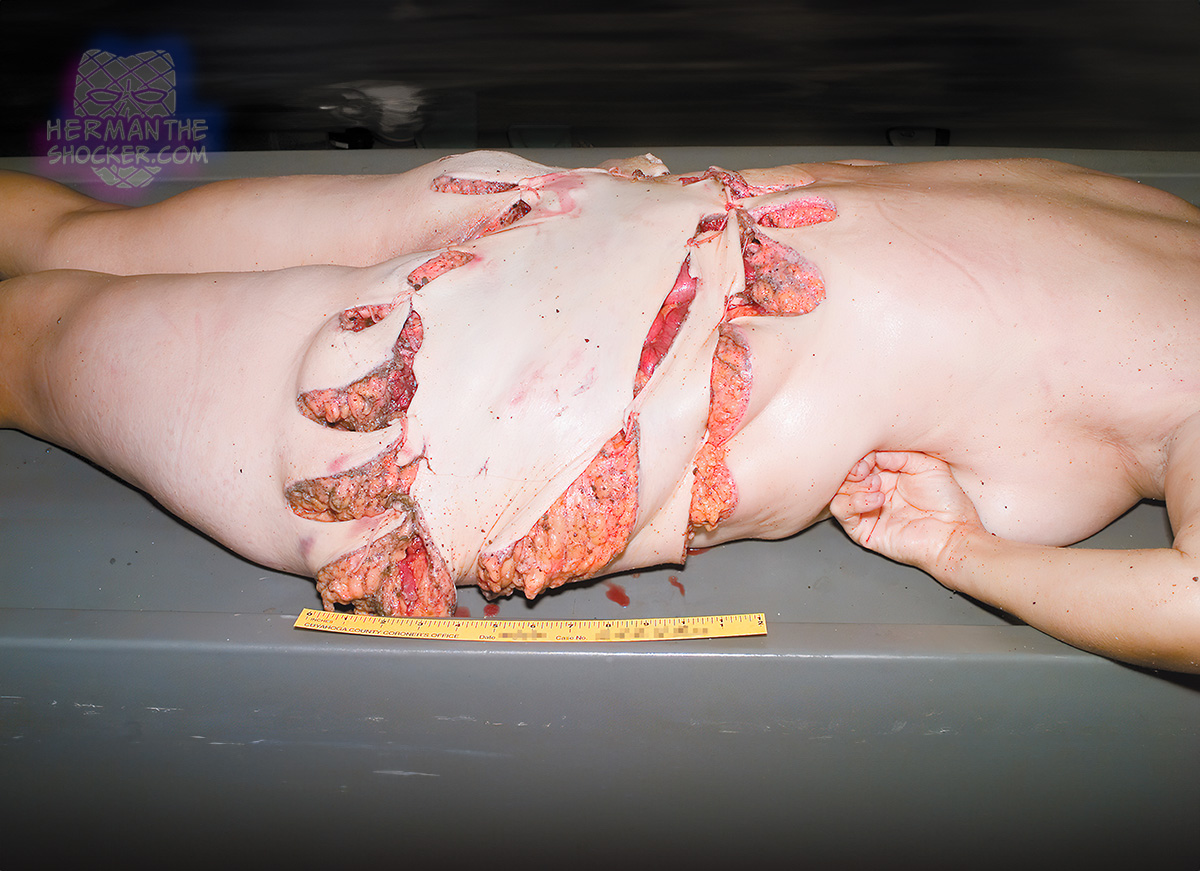 Fatal boat propeller chop wounds of the trunk