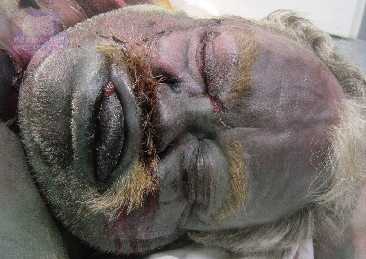 Protrusion of the tongue due to putrefactive gas formation