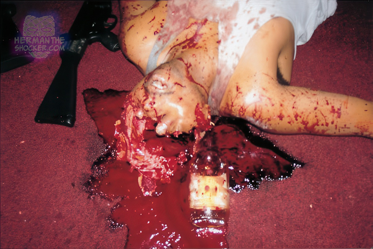 High velocity rifle wound