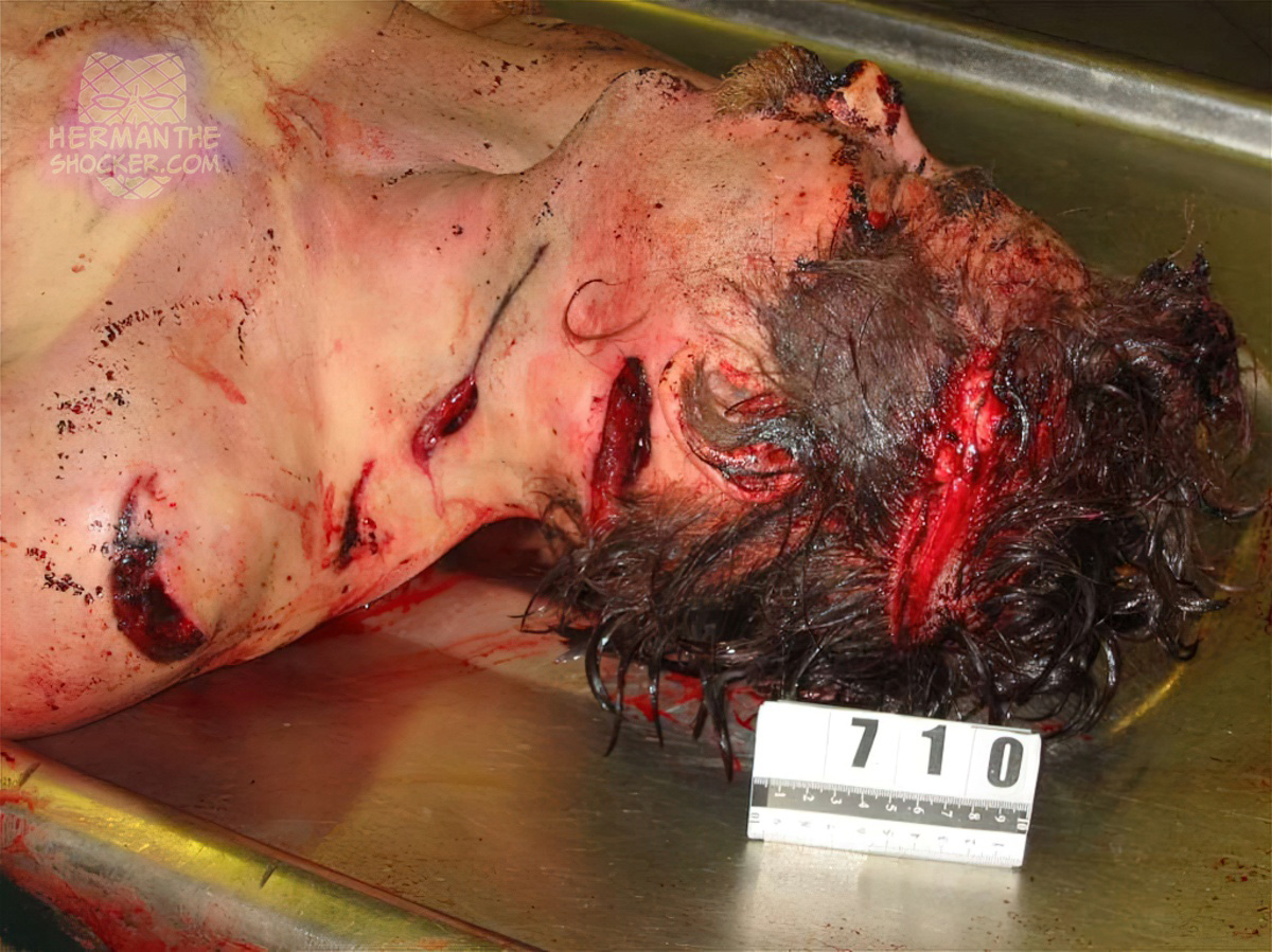 Cut and slash wounds