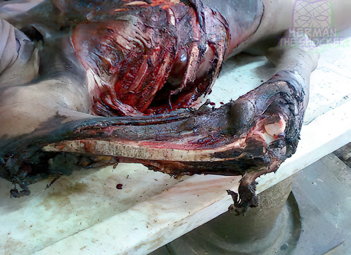 Bone abrasion due to the dragging force of a moving vehicle
