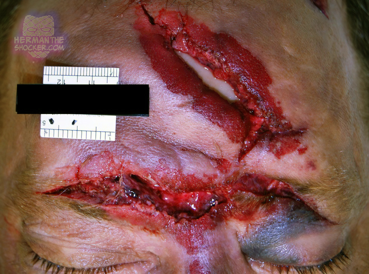 Blunt force trauma