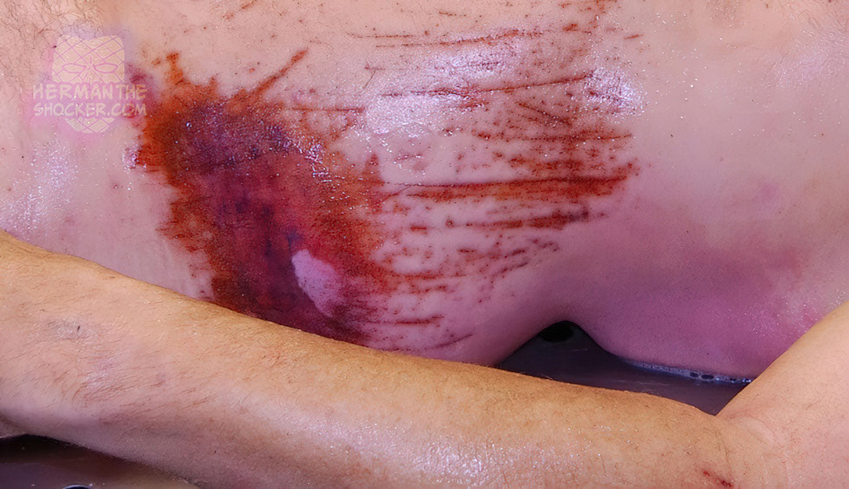 Brush-burn type abrasion