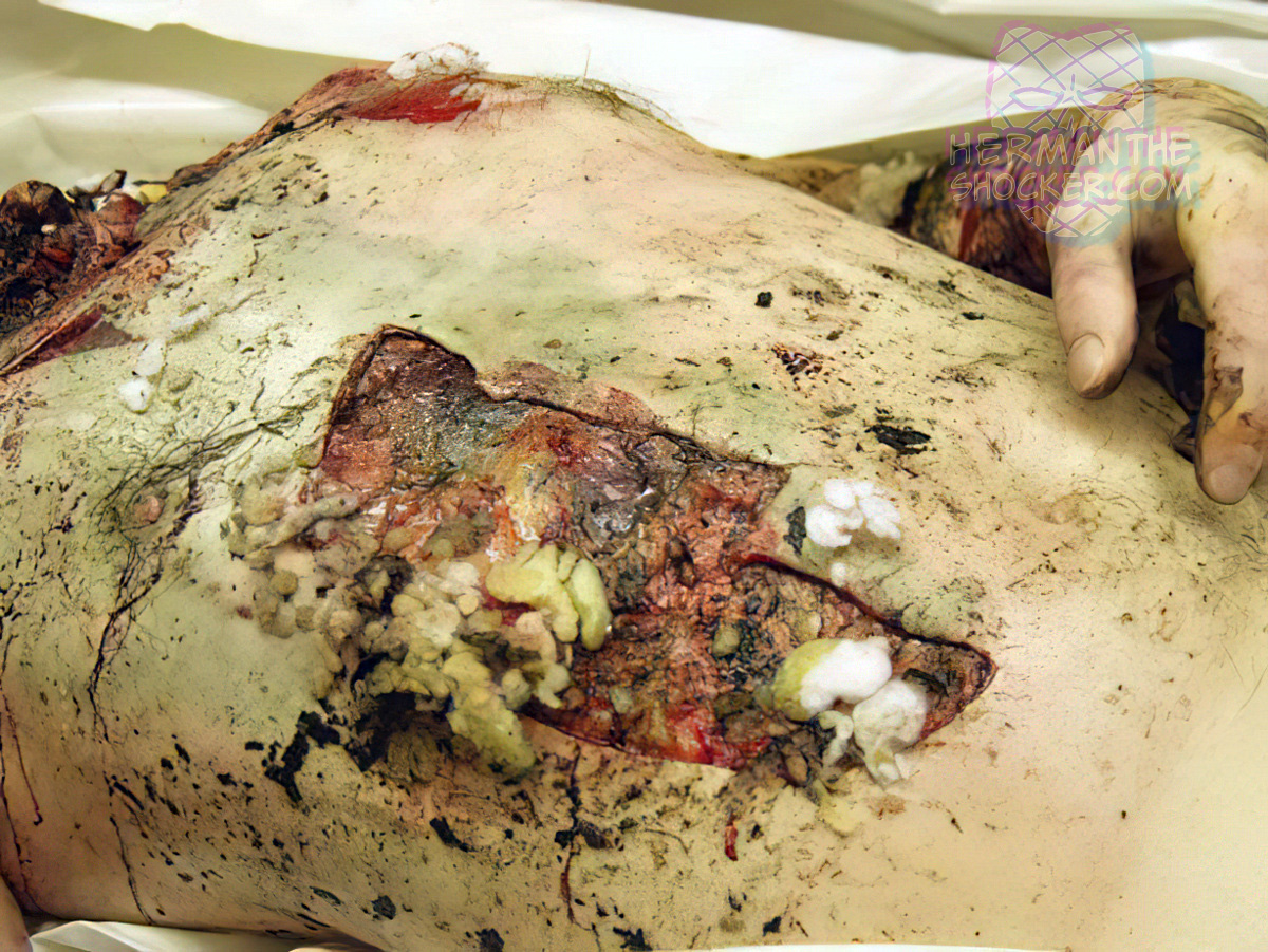 Opening of the abdominal body cavity